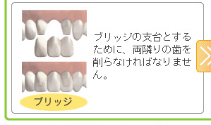 ブリッジの支台とするために、両隣りの歯を削らなければなりません。