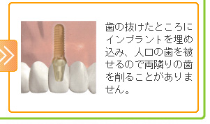 歯の抜けたところにインプラントを埋め込み、人口の歯を被せるので両隣りの歯を削ることがありません。