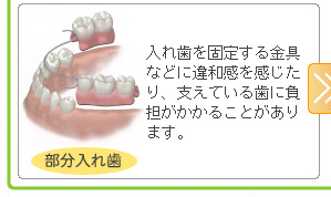 入れ歯を固定する金具などに違和感を感じたり、支えている歯に負担がかかることがあります。