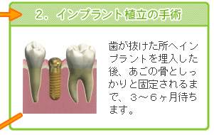 ２．インプラント植立の手術　歯が抜けた所へインプラントを埋入した後、あごの骨としっかりと固定されるまで、３～６ヶ月待ちます。