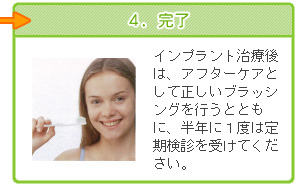 ４．完了　インプラント治療後は、アフターケアとして正しいブラッシングを行うとともに、半年に１度は定期検診を受けてください。